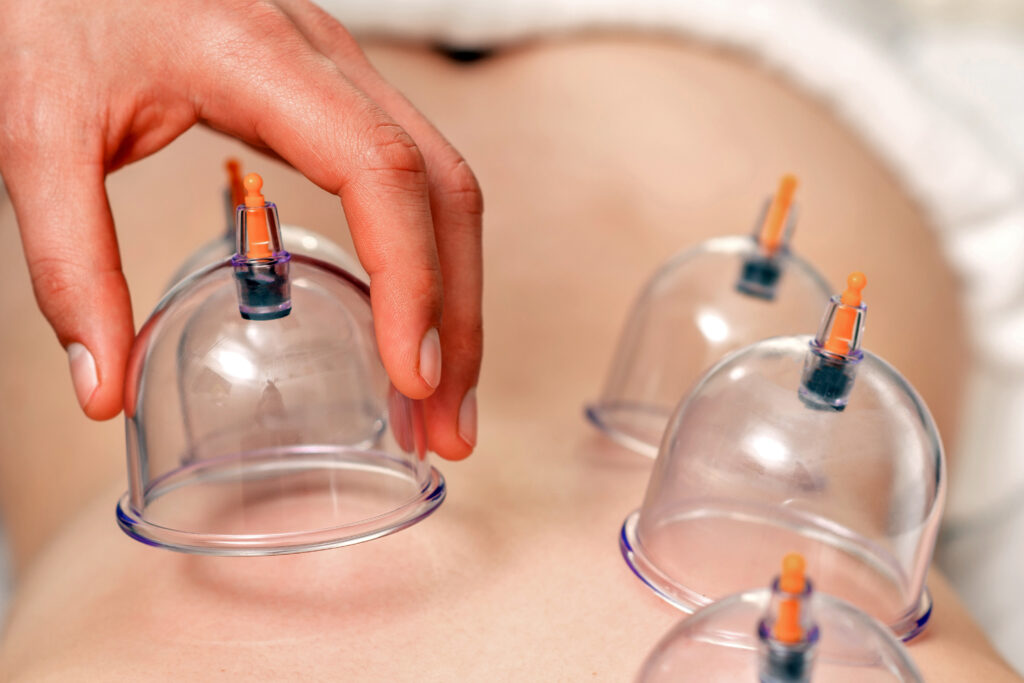 Hijama (Cupping Therapy)